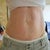 "Before" stretch marks