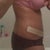 Day 26 - with the Scar Therapy Silicon Strips on - getting ready for work in the morning.  The treatment is very effective and minimally disruptive.