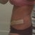 Day 26 - with the Scar Therapy Silicon Strips on - getting ready for work in the morning.  The treatment is very effective and minimally disruptive.