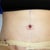 My new Belly Button...I think it looks kinda funky (maybe too small or too high). I guess I just got to get used to it.