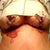 Just a couple hours after surgery. Breast implant removal with lift and No replacement implant.

dated 3/8/2012