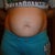 pre-op 3-4 months prego look and I am not even pregnant!