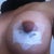 6 days post op Left Insicion