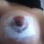 6 days Post op Right Insicion