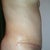 3 weeks Pos Op - side View...you can tell more of the swelling on the side view