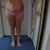 5 days after SmartLipo