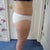 22 days after SmartLipo