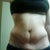 7wks post op and 11 lbs weight loss