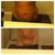 5 days before touch up lipo