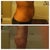 Side view- 5 days before touch up lipo
