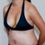 Day 5 post op. I still have stretch marks because my original stretch marks were way above my bb.