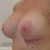 Left ~ 1 Day Post-Op