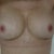 almost 2 weeks post surgery- looking much better