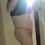 Right side 9 days post op. No overhanging skin! YEAH!