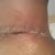 PO Day 21 - Incision still has some tension marks but they are becoming less aparent over time as the stomach stretches.