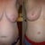 Before and after- 6 months PO