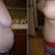 Before and after side shot- 6 months PO. You can really see the difference here.