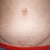 Tummy tuck scar- 6 months PO