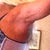 Arm Lift Scar 5 mos.