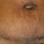 Day 11 - scar healing well