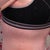 6 days post op