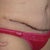 Some of the steri-strip has come off and my scar so far looks wonderful! I know it's too soon to tell, but I think it's going to look great.  I am only using Vitamin K on it and by bb so far.  so far so good!!!