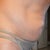 Side view before tummy tuck.
