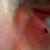 Evolence bumps left side requiring oral prednisone