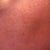 46 HOUR POST-TREATMENT LEFT
