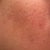 46 hour POST-TREATMENT RIGHT