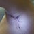 Hole in my armpit, closed up.  Phew!  That's at about 14 days post-op, I think