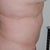 Another angle before surgery
