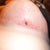 Hole with scab left side day 17