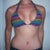 3 weeks post op!