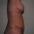 3 weeks post-op