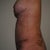 3 weeks post-op