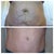 Before and 9 months PO used Pic Stitch app on iphone