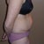 Side view pre-tummy tuck