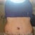 Front view 8 days post op.  Belly button and stomach pretty swollen.