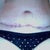 3 weeks after surgery and stitches removed from TT incision and belly button. BB looks normal! Thank goodness!