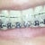 18 months into treatment. Debracing in about 4 week's time. A little gap has formed on top and bottom. They're addressing those issues with some clear elastic string. YAY!