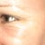 after one fraxel:restore, next day- smiling... puffy though