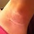Left incision, 3 weeks