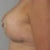 Drains Removed Post Op Day 8 Left Side