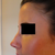 Day 7 -  SPLINT OFF! - left profile. My doctor says the remaining bump is just the skin retaining the shape of the old bump. Should go away with time.