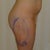 Notice the large bruise, this is the same place the bump is in the front view picture.
