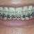 No elastics needed 14 months into treatment.