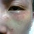 Day 4: Swollen and patchy skin