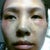 Dark red marks under eyes. Still swollen.