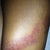 1 week post op bruising